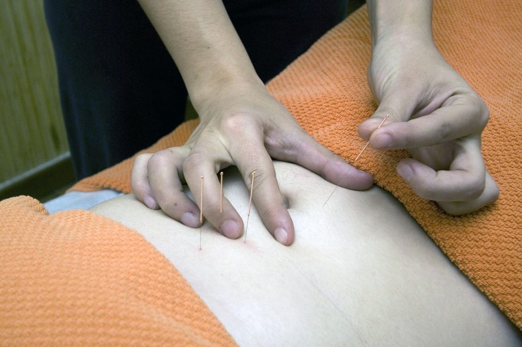 Séance d'acupuncture