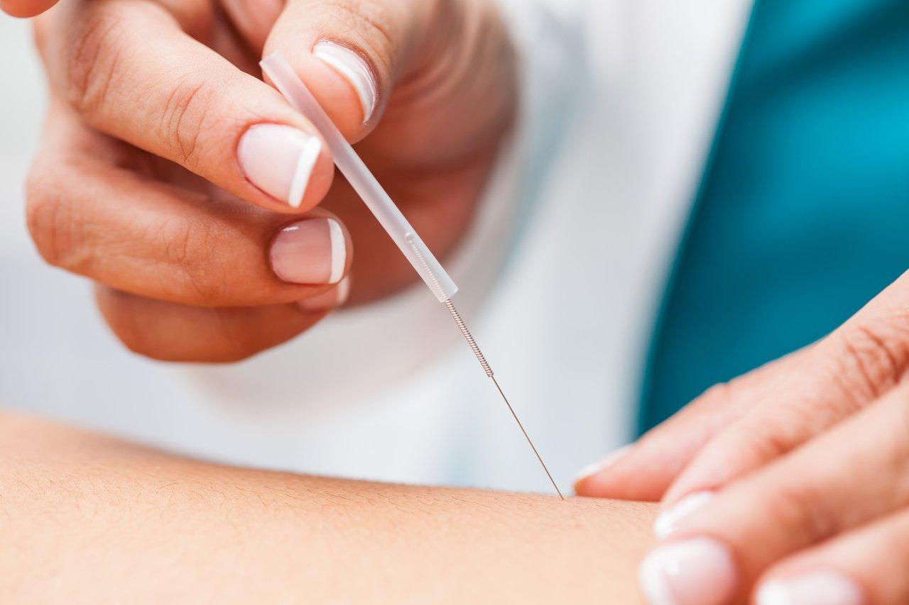 Recherche en acupuncture en 2024 : un médecin pratique une séance pour évaluer ses effets.
